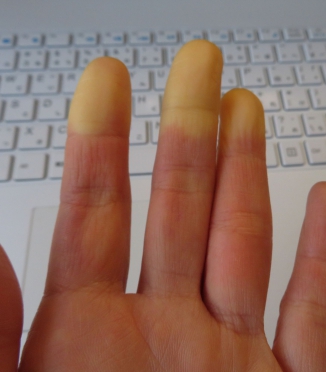 Raynaud' sündroom ja uni — miks öösel külmetavad käed ja jalad ja kuidas sellega võidelda