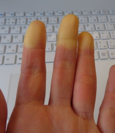 Raynaud' sündroom ja uni — miks öösel külmetavad käed ja jalad ja kuidas sellega võidelda